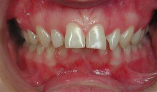 Vervallen pleegouders Fahrenheit Orthodontie volwassen - voorbeelden - voorbeet / cl ii - Churchill  Orthodontics bvba